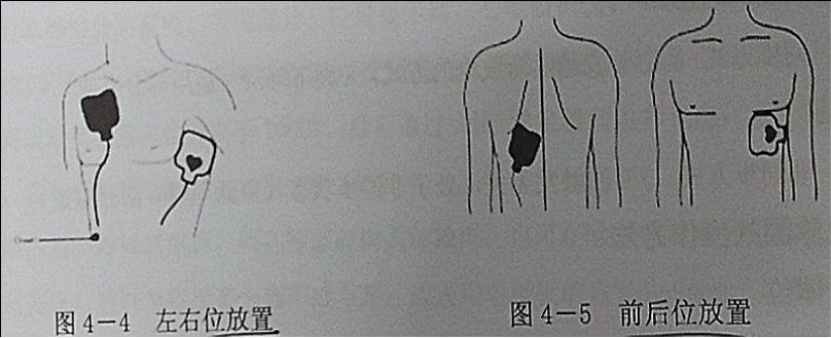 除颤电极选购指南(图2)